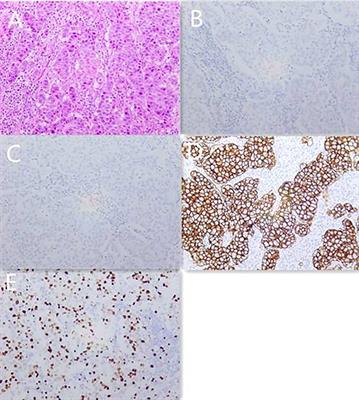 HER2-positive metastatic breast cancer with brain metastases responds favorably to pyrotinib and trastuzumab-based treatment: A case report and literature review